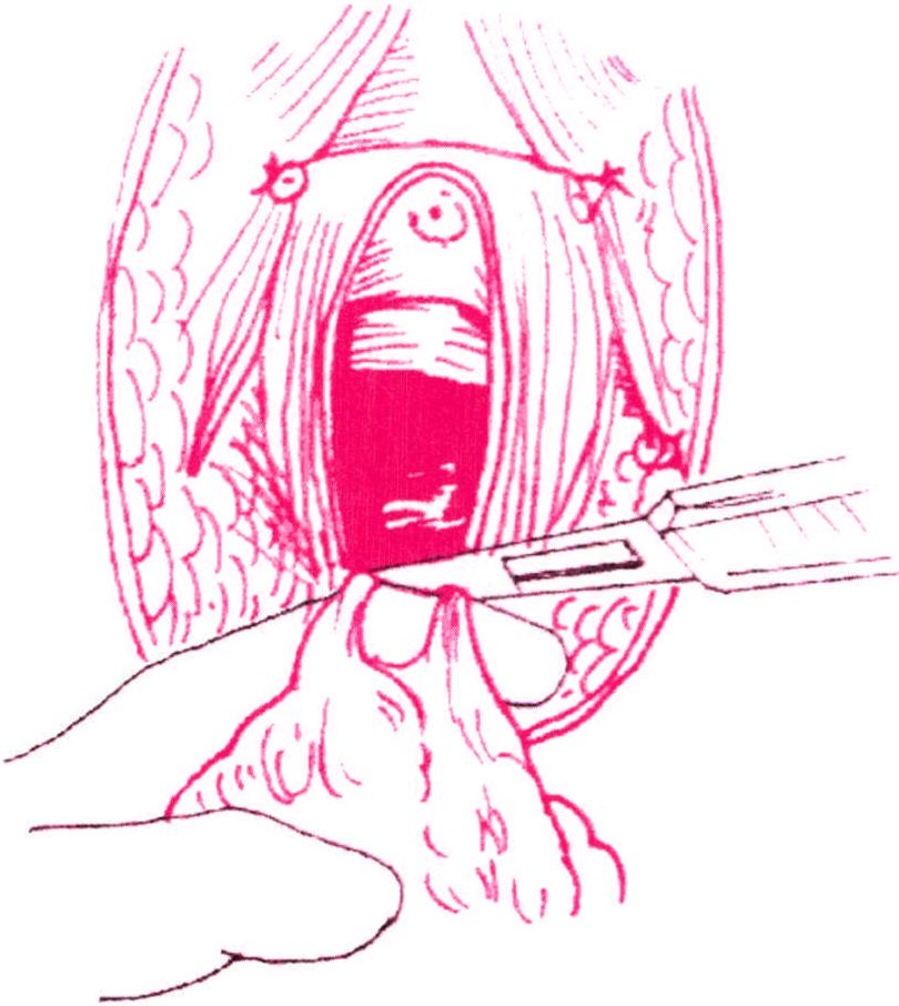 第九節(jié) 廣泛外陰切除術(shù)